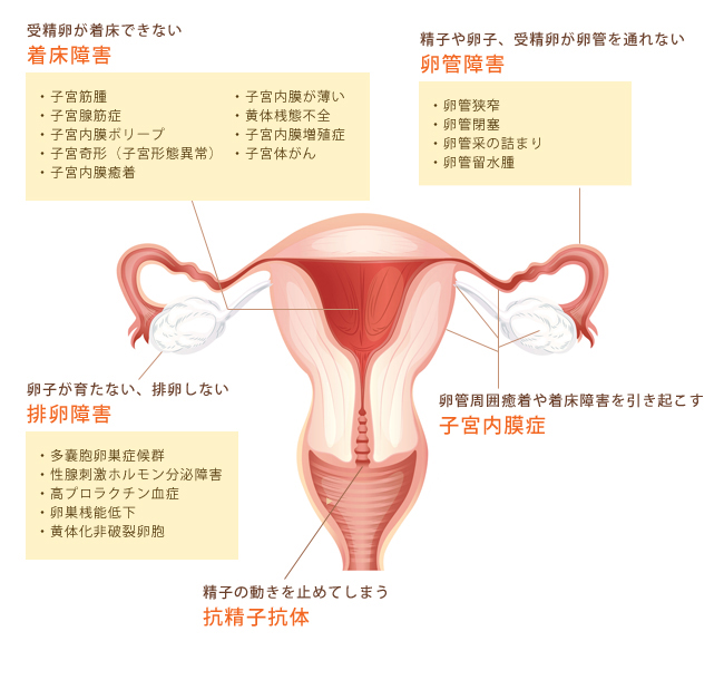 女性側の主な不妊の要因を見る 